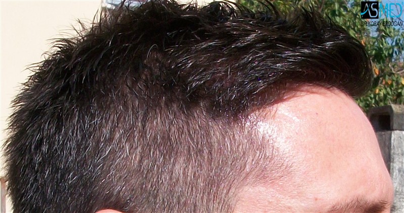 Before and After  graft    transplant at 