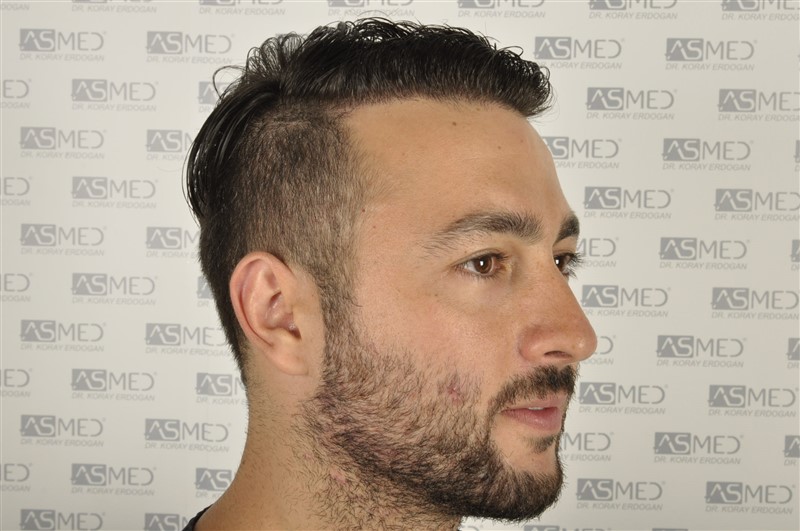 Before and After  graft    transplant at 