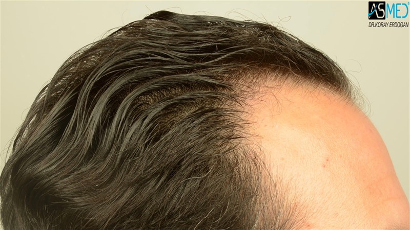 Before and After  graft    transplant at 