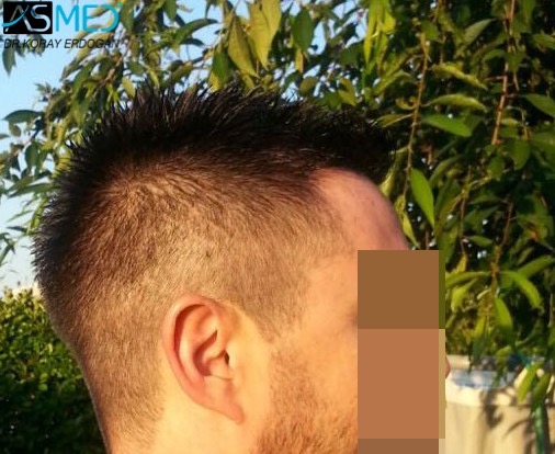Before and After  graft    transplant at 