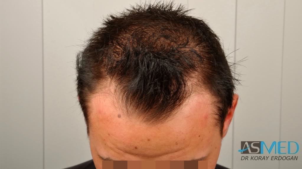 Before and After  graft    transplant at 