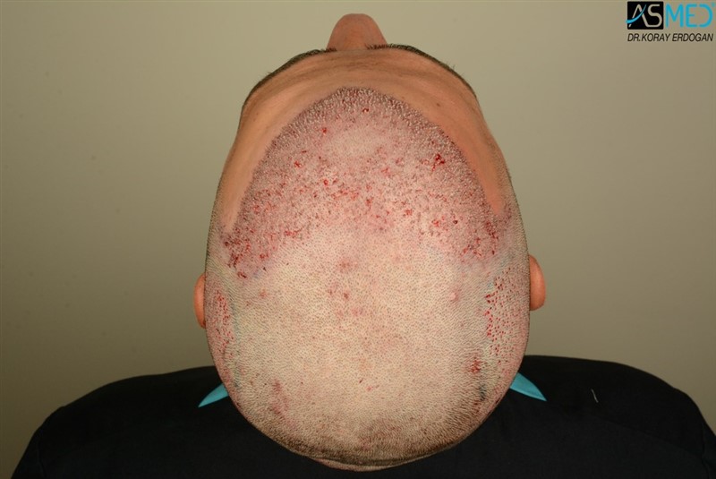 Before and After  graft    transplant at 