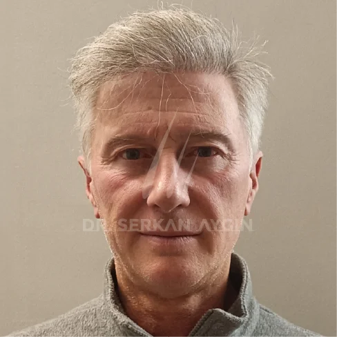 DHI Hair Transplant Result