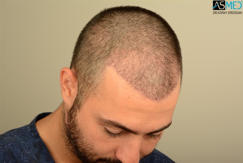 Before and After  graft    transplant at 