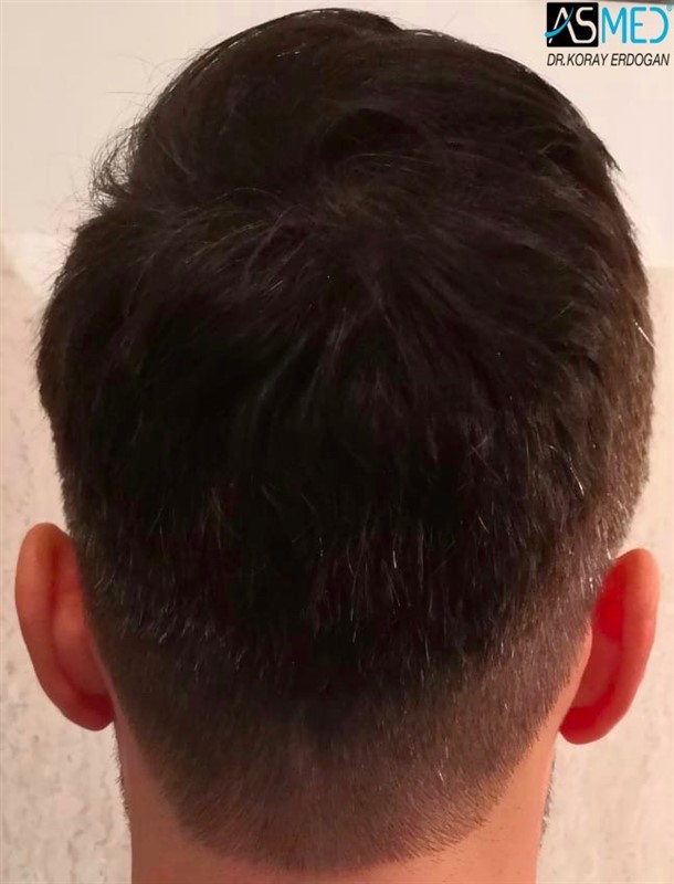 Before and After  graft    transplant at 