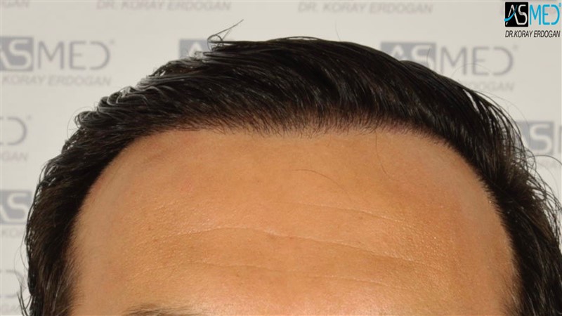 Before and After 3012 graft  FUE hair transplant at ASMED Medical Center