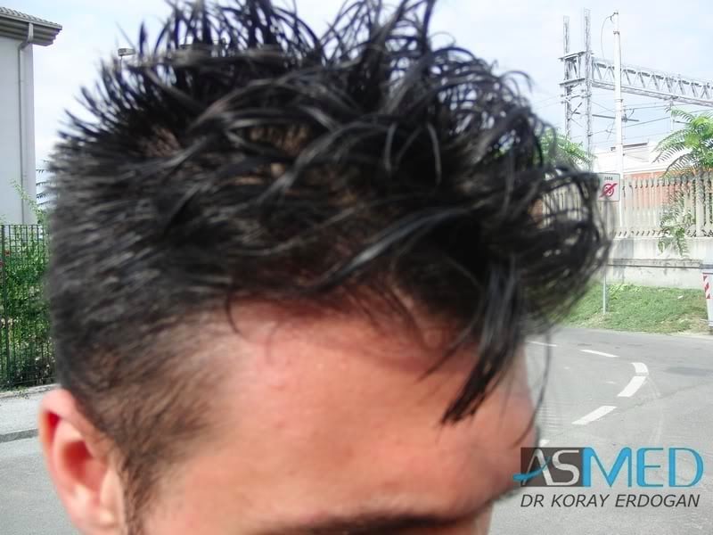 Before and After  graft    transplant at 
