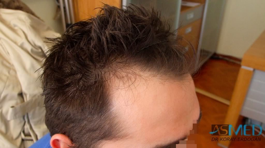 Before and After  graft    transplant at 