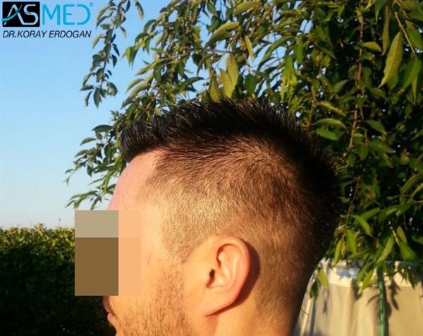 Before and After  graft    transplant at 