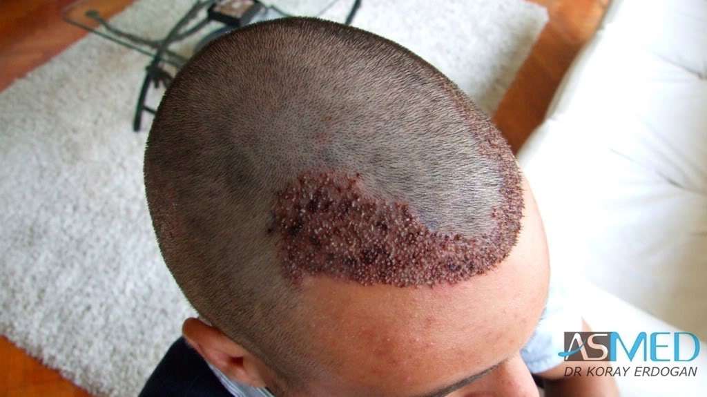 Before and After  graft    transplant at 