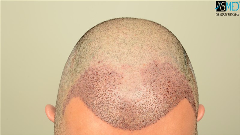 Before and After  graft    transplant at 