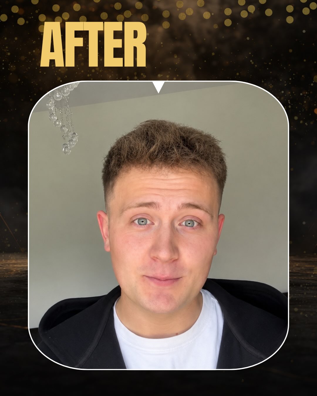 Before and After  graft    transplant at 