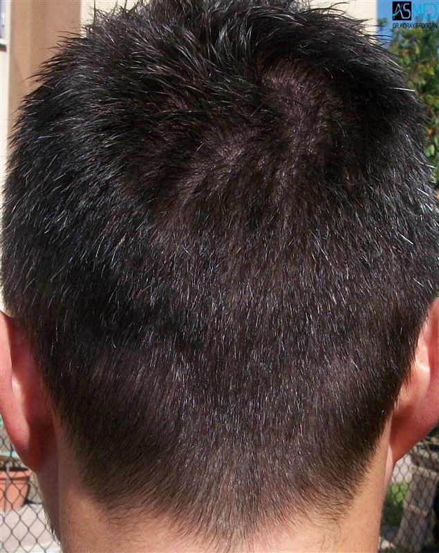 Before and After  graft    transplant at 
