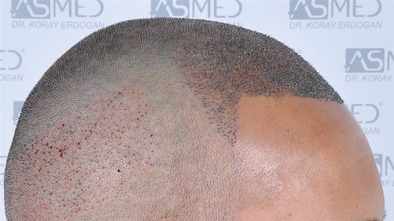 Before and After  graft    transplant at 