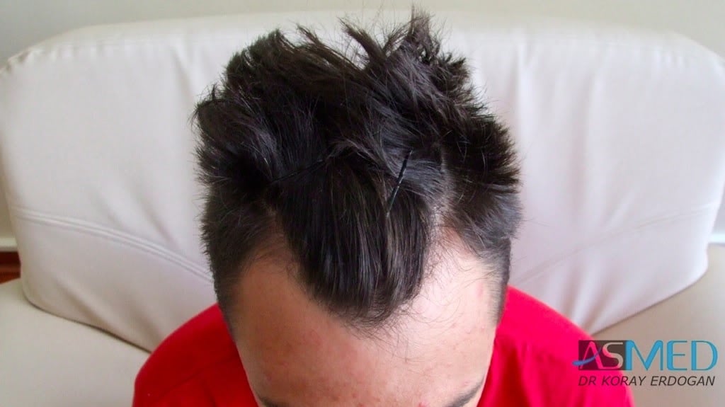 Before and After  graft    transplant at 