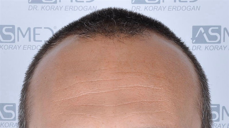 Before and After  graft    transplant at 