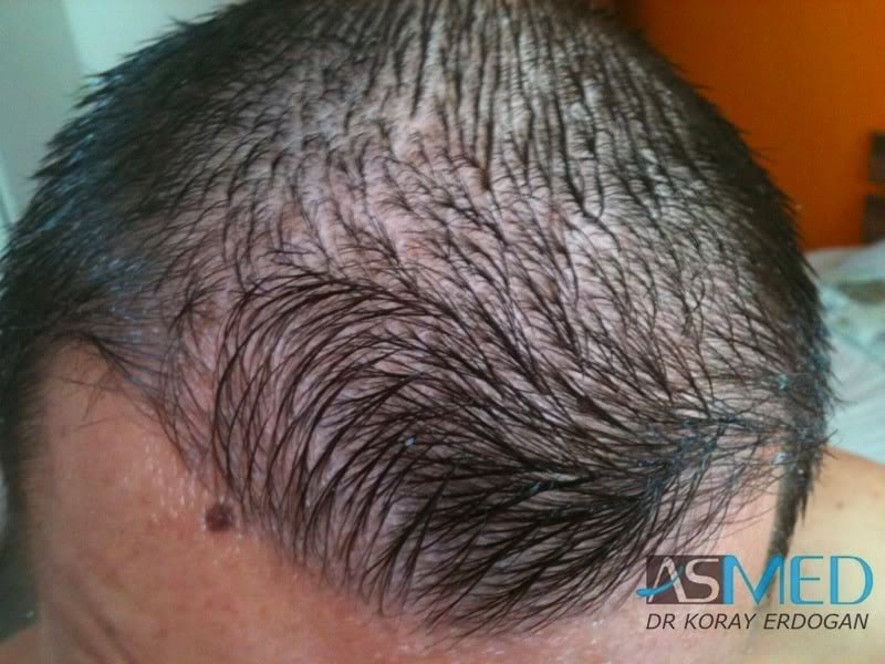 Before and After  graft    transplant at 
