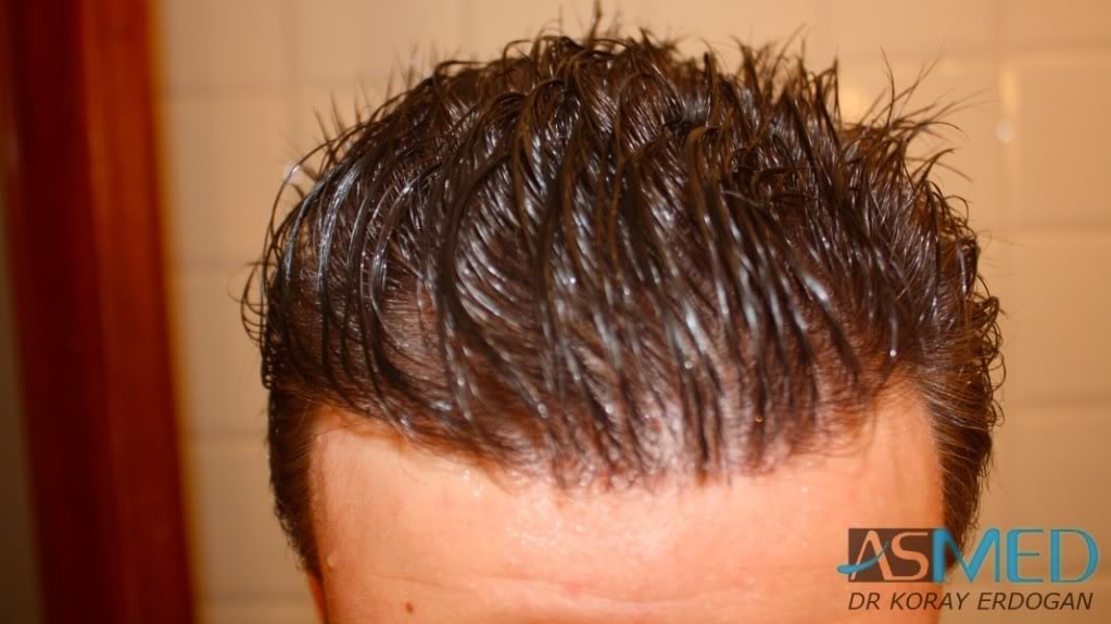 Before and After  graft    transplant at 