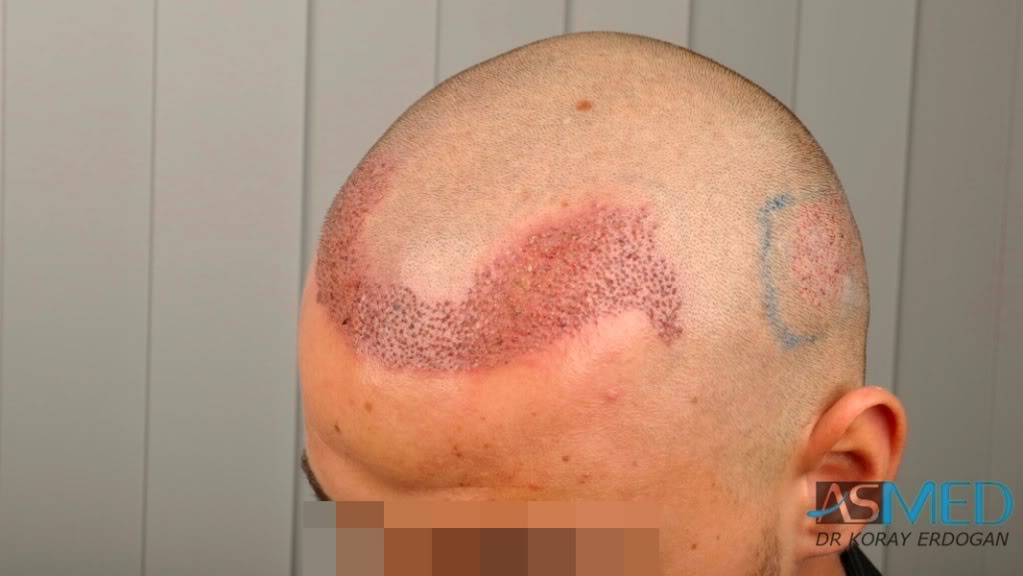 Before and After  graft    transplant at 