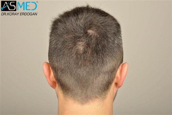 Before and After  graft    transplant at 