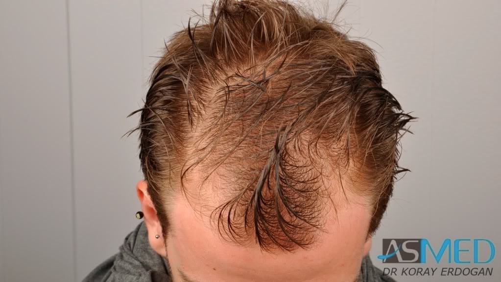 Before and After  graft    transplant at 