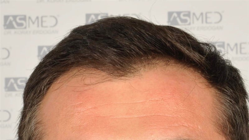 Before and After  graft    transplant at 