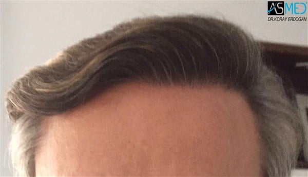 FUE Hair Transplant Result