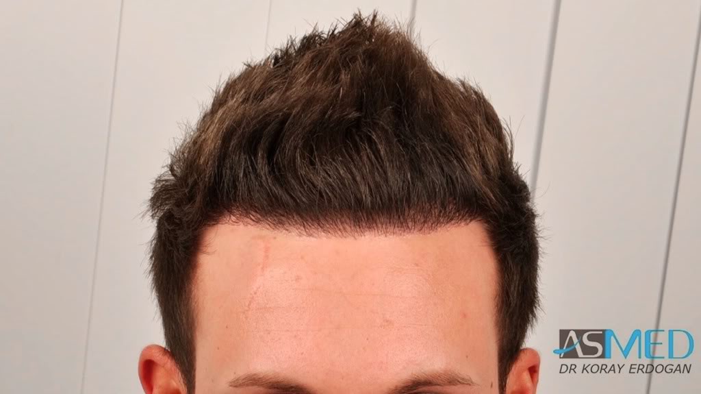 Before and After 1800 graft  FUE hair transplant at ASMED Medical Center