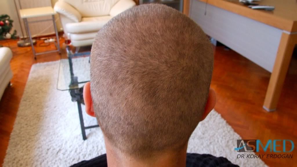 Before and After  graft    transplant at 