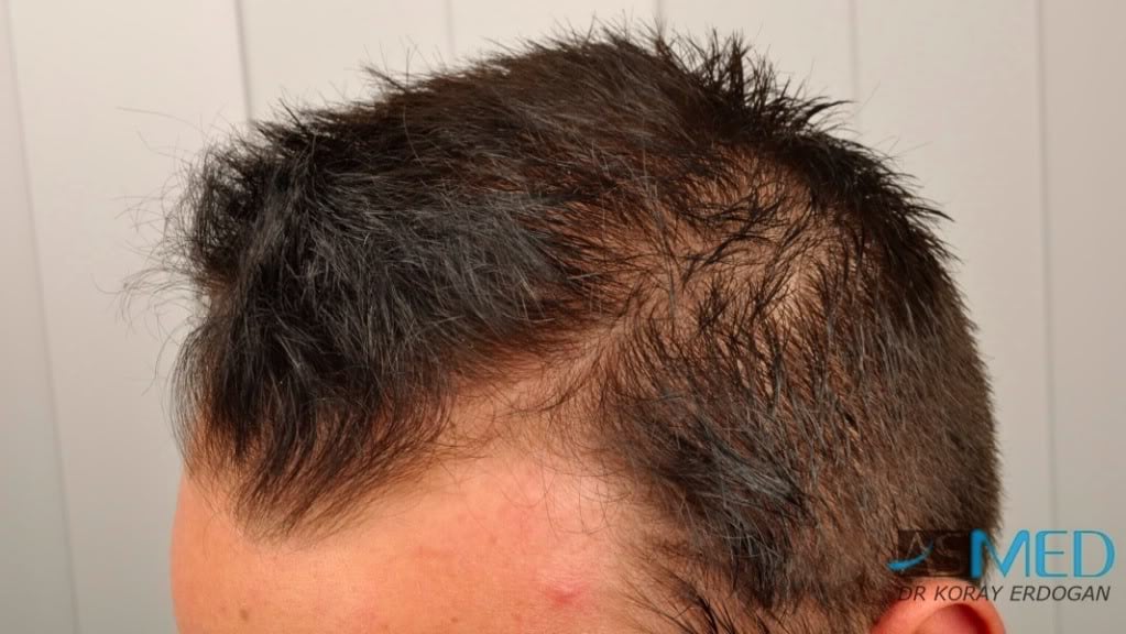 Before and After  graft    transplant at 