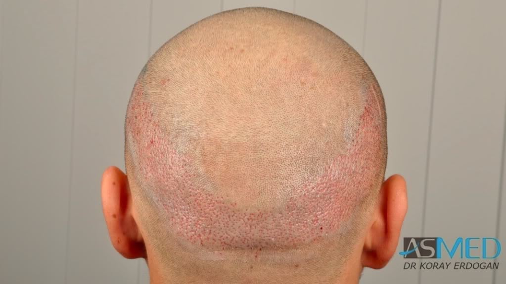 Before and After  graft    transplant at 
