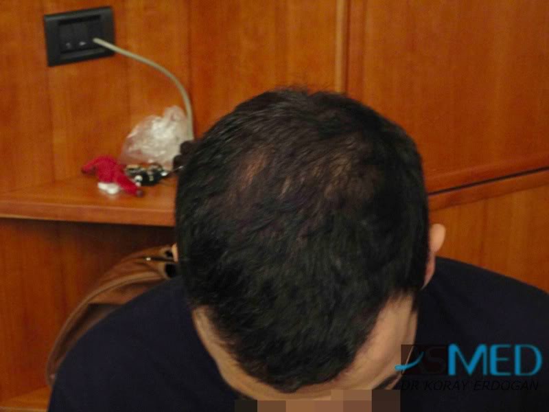 FUE Hair Transplant Result