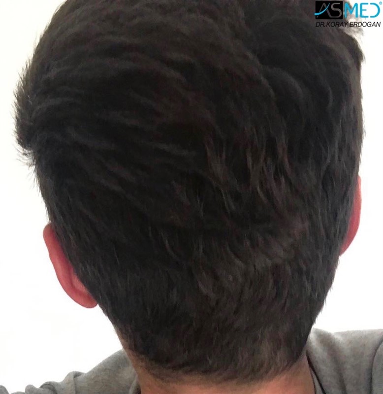 Before and After  graft    transplant at 