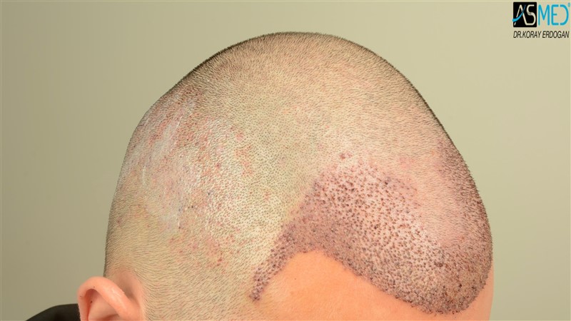 Before and After  graft    transplant at 