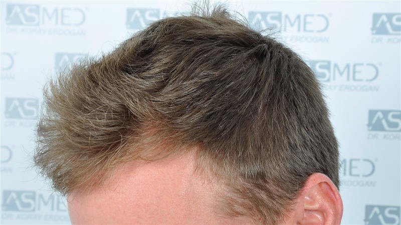 Before and After  graft    transplant at 
