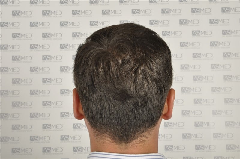 Before and After  graft    transplant at 