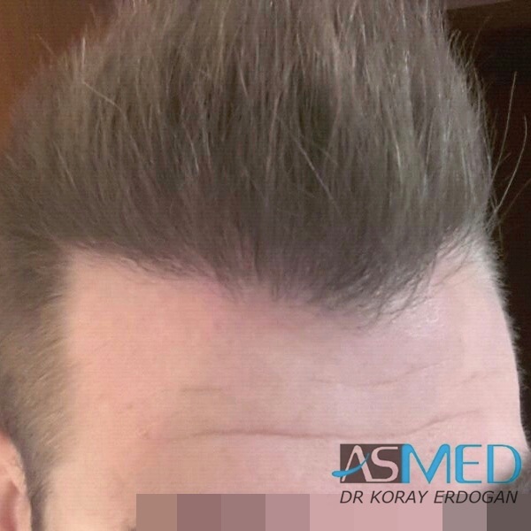 Before and After  graft    transplant at 