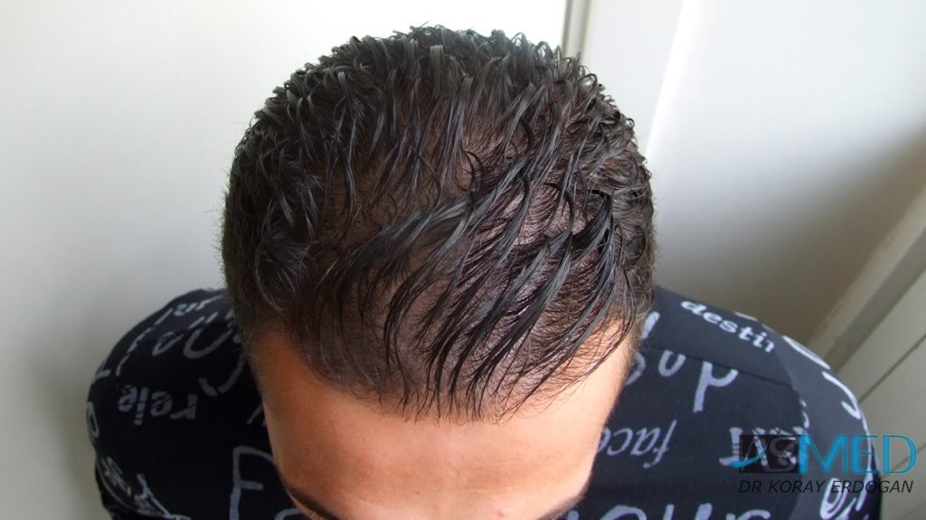 Before and After  graft    transplant at 