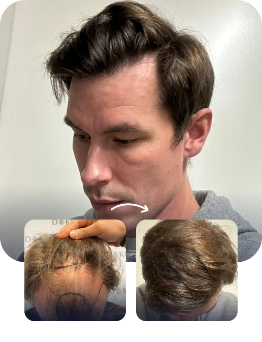 DHI Hair Transplant Result