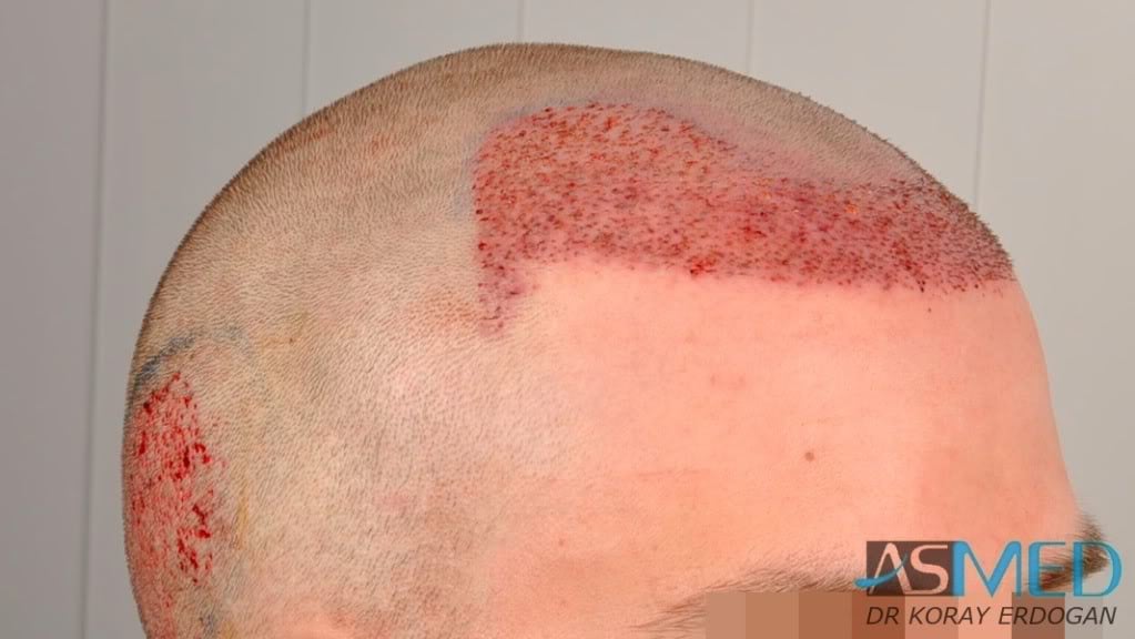 Before and After  graft    transplant at 