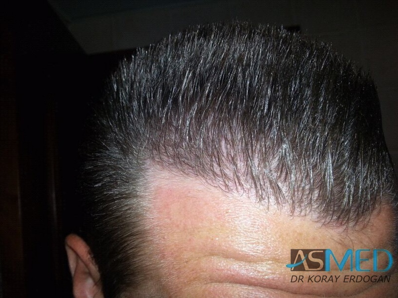 Before and After  graft    transplant at 