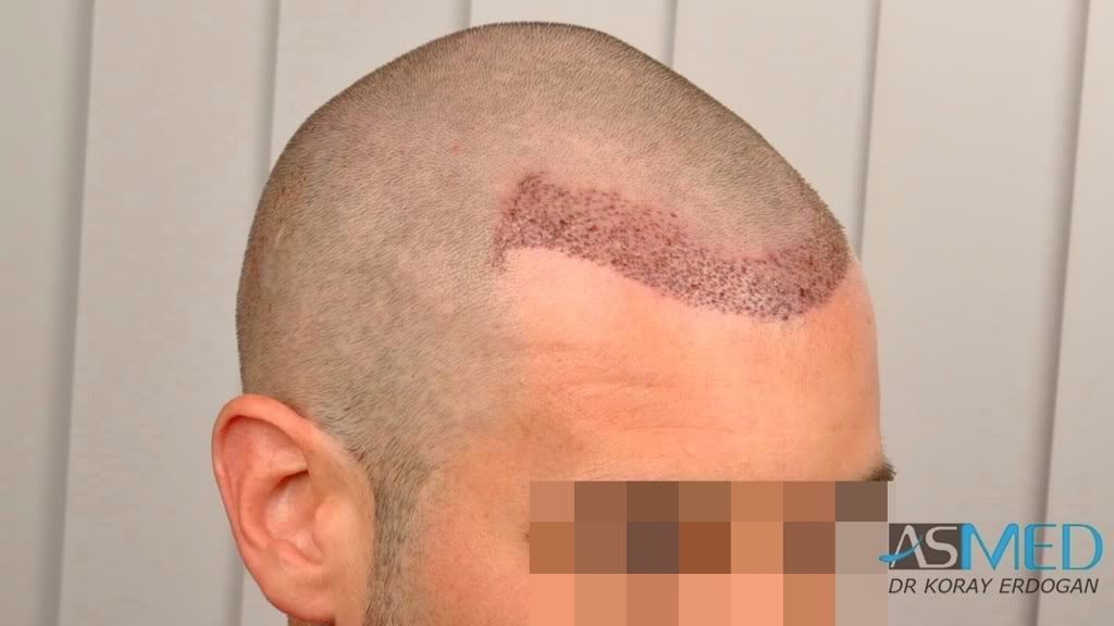 Before and After  graft    transplant at 