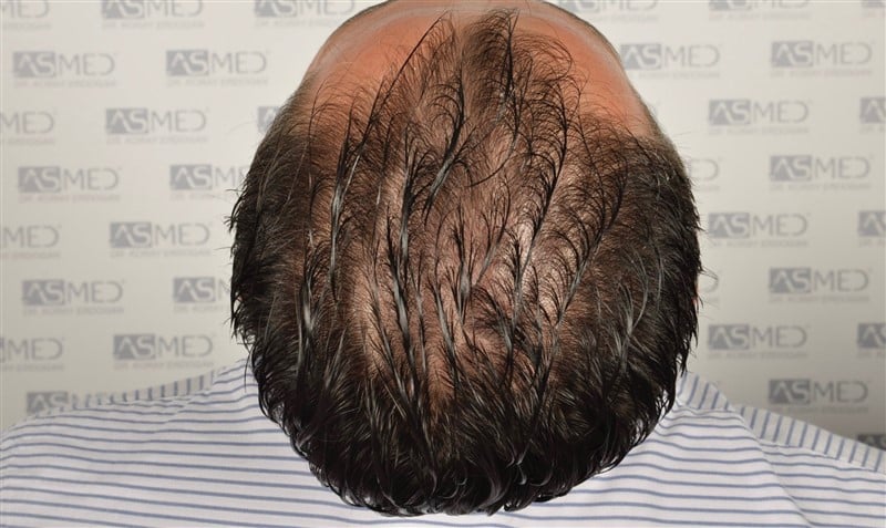 Before and After  graft    transplant at 