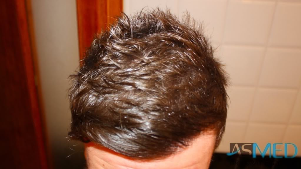 Before and After  graft    transplant at 