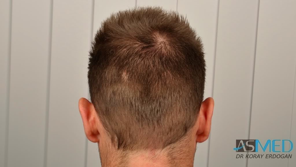 Before and After  graft    transplant at 