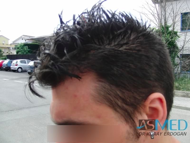 Before and After  graft    transplant at 
