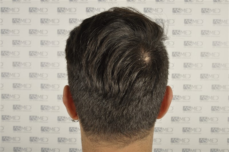 Before and After  graft    transplant at 
