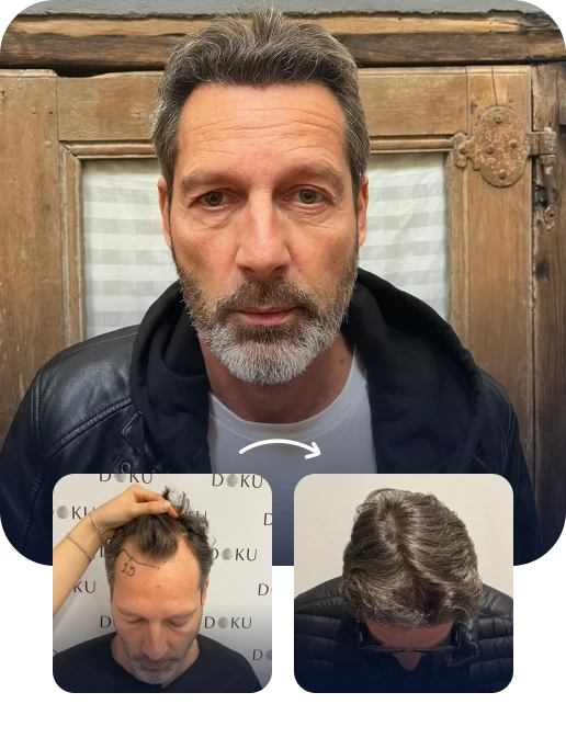 FUE Hair Transplant Result