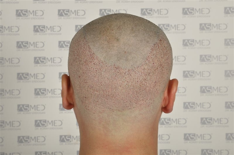 Before and After  graft    transplant at 