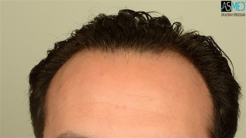 Before and After  graft    transplant at 